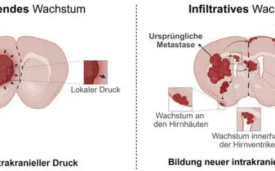 Metastasen: Studie aus Regensburg und Erlangen widerlegt alte Annahme