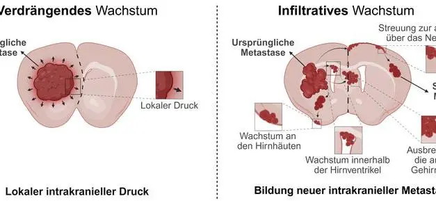 Metastasen: Studie aus Regensburg und Erlangen widerlegt alte Annahme