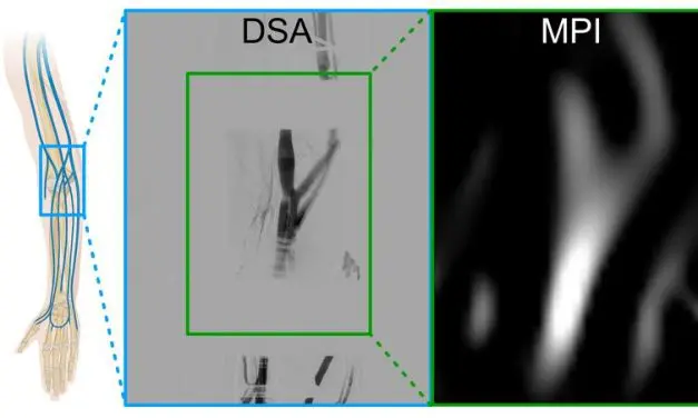 Würzburg: Magnetpartikelbildgebung erstmals am Menschen eingesetzt