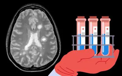 Forschende entdecken neue Biomarker für Multiple Sklerose