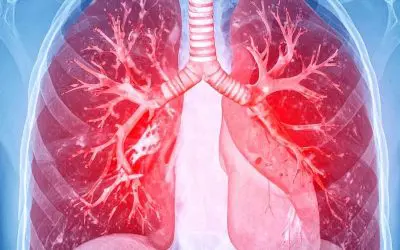 Kathetergestützte Ultraschall-Thrombolyse senkt Risiko bei schwerer Lungenembolie deutlich