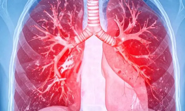 Kathetergestützte Ultraschall-Thrombolyse senkt Risiko bei schwerer Lungenembolie deutlich