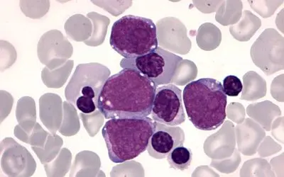 GATA1-Mutation befeuert Leukämie-Entstehung bei Kindern mit Down-Syndrom