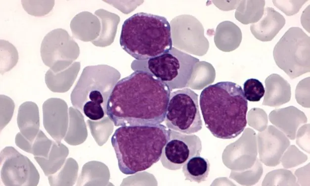 GATA1-Mutation befeuert Leukämie-Entstehung bei Kindern mit Down-Syndrom