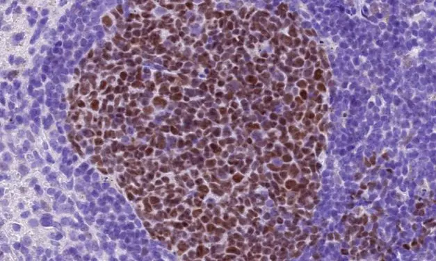 cFLIP als neue Angriffsstelle gegen therapieresistente Lymphome entdeckt