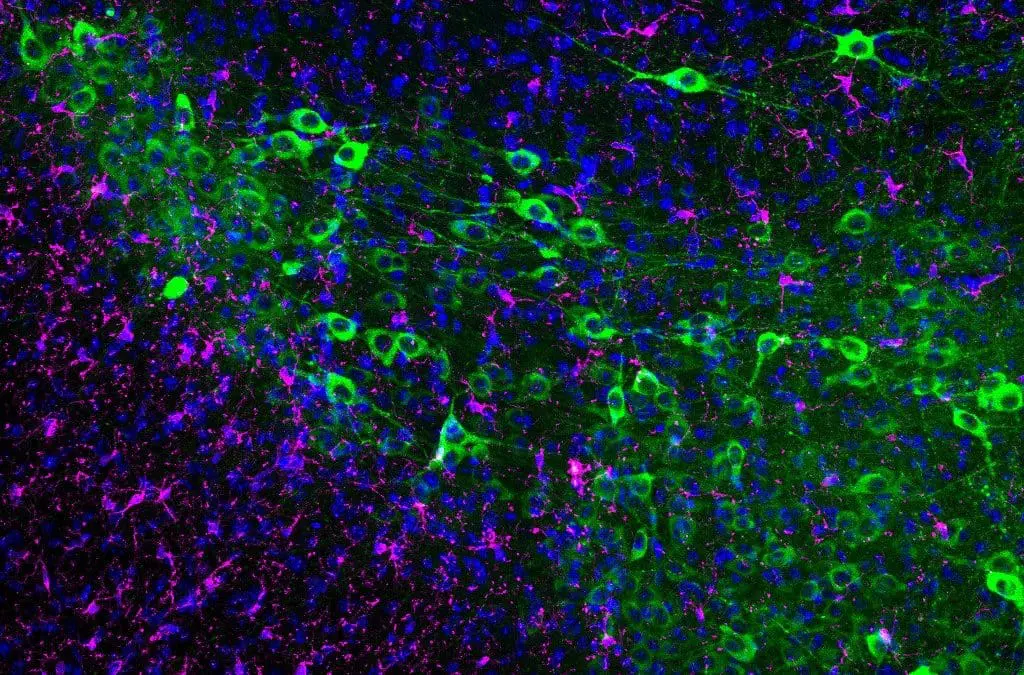 Neue Immunzellen im Alzheimer-Gehirn entdeckt