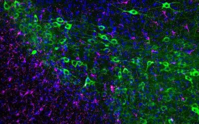 Neue Immunzellen im Alzheimer-Gehirn entdeckt