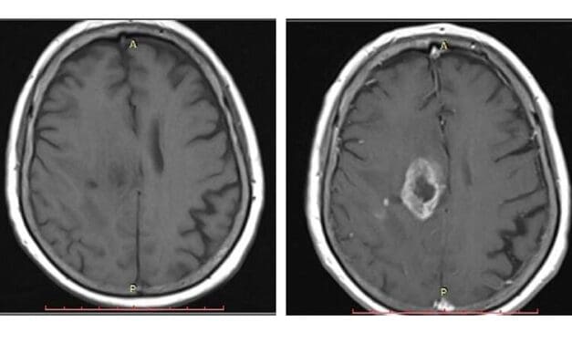 MRT: Radiologische Diagnostik kann Gadoliniumdosis halbieren