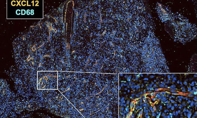 Spiegelmere sollen Glioblastome bekämpfen