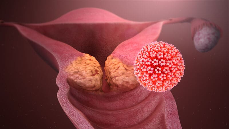 HPV infection can cause cervical carcinoma. Credits: Wikipedia/ CC BY-SA 4.0 