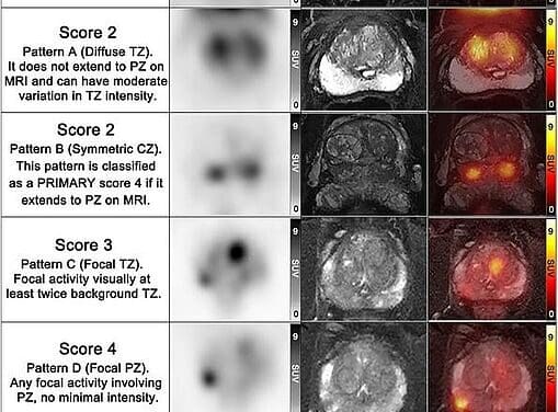 Bildgebende Verfahren: PET/MRT kann unnötige Biopsien bei Prostatakrebs vermeiden helfen