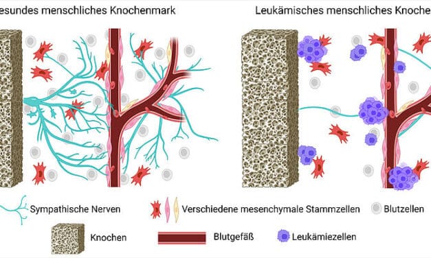 AML und und Chemotherapie schädigen langfristig das Nervensystem im Knochenmark