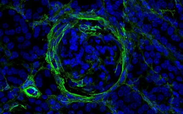 Autoimmunerkrankungen: Auslöser für Nierenschäden bei Lupus ausgemacht