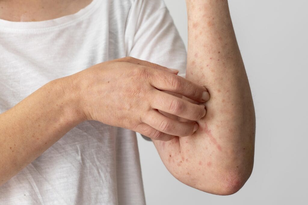 Hautausschläge gehören zu den Symptomen einer Allergie und können in vielen Formen auftreten, beispielsweise als Ekzeme, Kontaktdermatitis und Nesselsucht. (Credits: freepik)