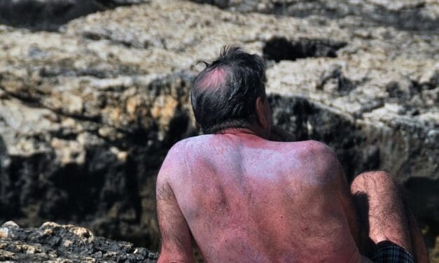 Falsche Lehrmeinung: RNA, nicht DNA, ist die Hauptursache für akuten Sonnenbrand