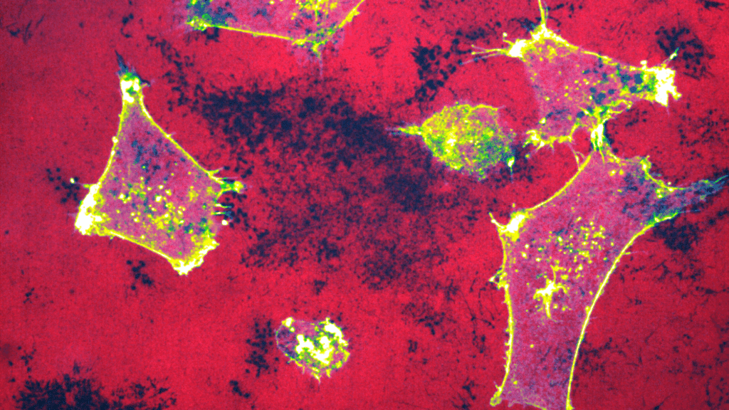 Krebszellen, die ihre umgebende Matrix abbauen. Mikroskopische Aufnahme von invasiven Brustkrebszellen (gelb markiert), die ihre darunter liegende extrazelluläre Matrix abbauen (rot markierte Gelatine, degradierte Bereiche erscheinen als schwarze Löcher). Bild zur Verfügung gestellt von Omkar Joshi, Turku Bioscience Centre, Universität Turku. Maßstabsbalken, 20µm