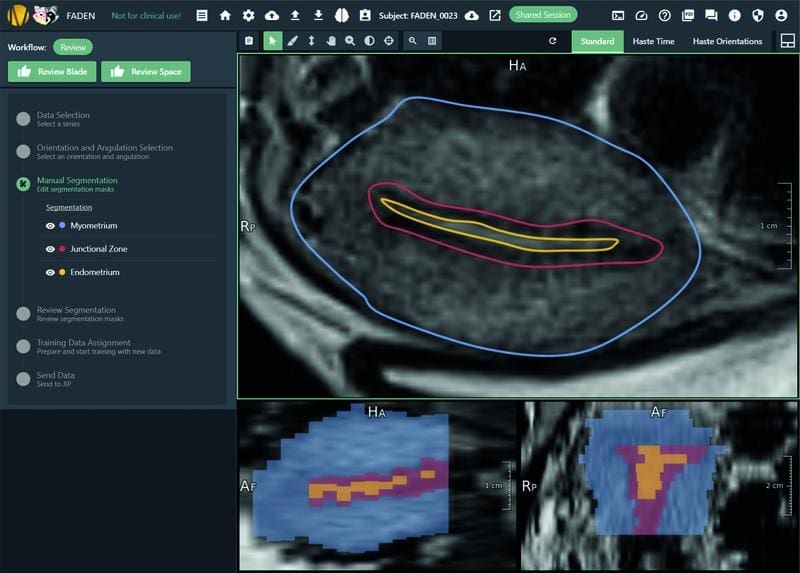 Der dreischichtige Aufbau des Uterus im MRT nach dem Segmentierungsprozess mit dem CuraMate FADEN-Workflow (blau = Myometrium, rot = Junktionale Zone, gelb = Endometrium) | Copyright: Fraunhofer MEVIS