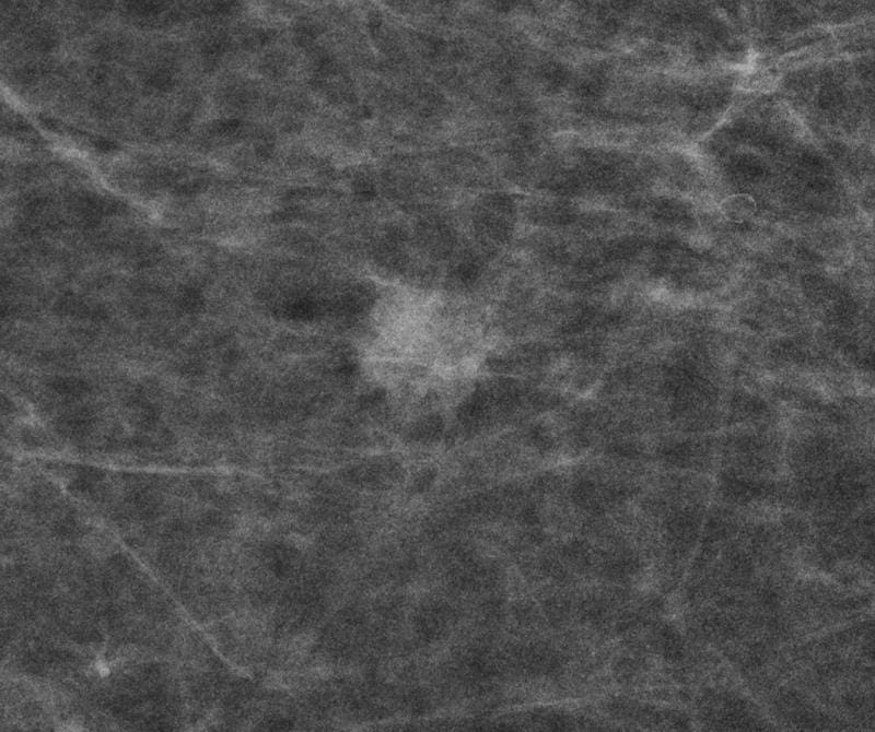 Screening-detected breast carcinoma, represented by a blurred focus; histology: breast carcinoma of non-special type, grade 2: @Reference Center Mammography Münster