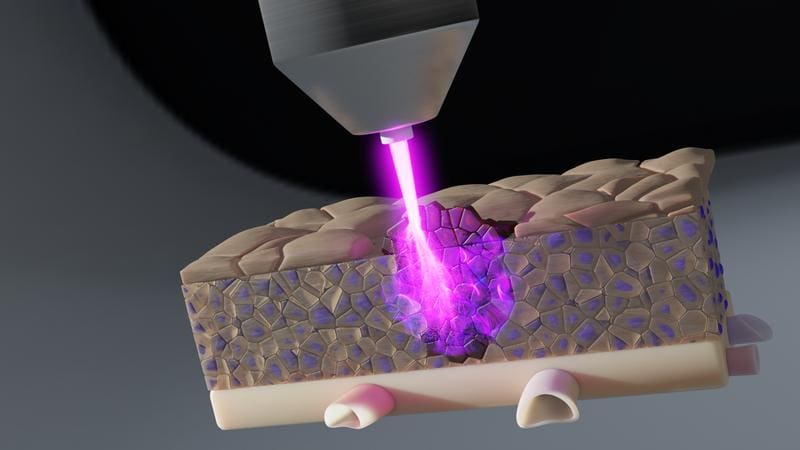 Reactive oxygen molecules formed by plasma therapy can penetrate deep into the tissues. In this way, tumor cells can also be reached and killed in deeper tissue layers. | Copyright: INP