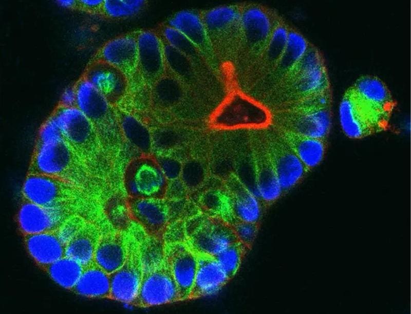 Mini-tumors, so-called organoids, are made from tissue from rectal cancer. They serve as a model of the tumor to test new therapies. | Copyright: Johannes Betge    