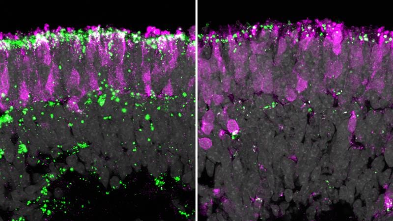 The image on the left shows the retinal organoid with the toxic lipofuscin deposits (green) typical of CLN2 disease, which affect the photoreceptors (pink). On the right, almost no deposits can be seen after gene therapy. | Copyright: Kevin Achberger