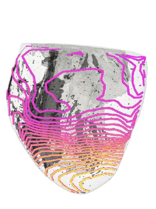 The electrical excitation propagation (colored) on a heart is very individual. Scar tissue (gray) interferes with this spread. | Source: University Medical Center Freiburg | Copyright: University Medical Center Freiburg    
