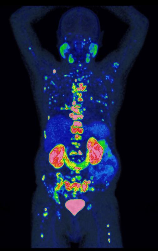 The image shows the result of a prostate-specific membrane antigen positron emission tomography. PSMA-PET is a state-of-the-art imaging method that can be used to visualize prostate cancer cells with particular precision. | Source: Prof. Dr. Wolfgang Fendler | Copyright: UDE, Prof. Dr. Wolfgang Fendler