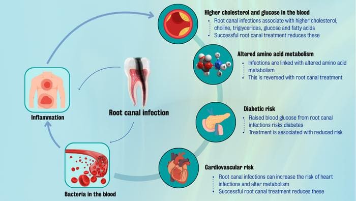 Infections of the root canal can cause bacteria to enter the bloodstream, which can lead to inflammation, heart disease and an increased risk of diabetes. Successful treatment reduces these risks. Credits: King's College London