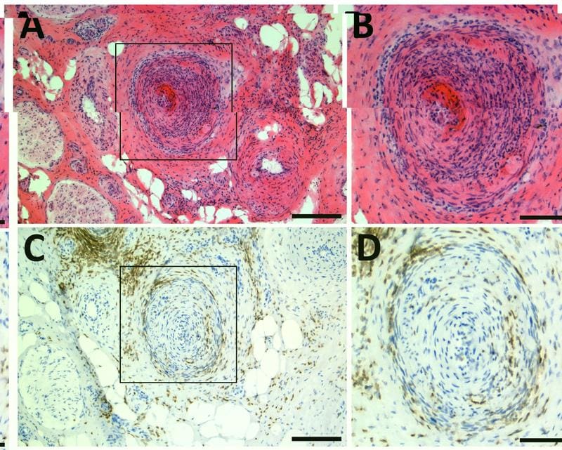 Suralis nerve biopsy of a patient with vasculitic polyneuropathy. (A, B) Hematoxylin-eosin staining with marked inflammation; (C, D) CD3 immunohistochemistry shows dense T-cell infiltration of the vessel. Scale: 200 μm (A, C), 100 μm (B, D) | Source: Julia Grüner | Copyright: FM      