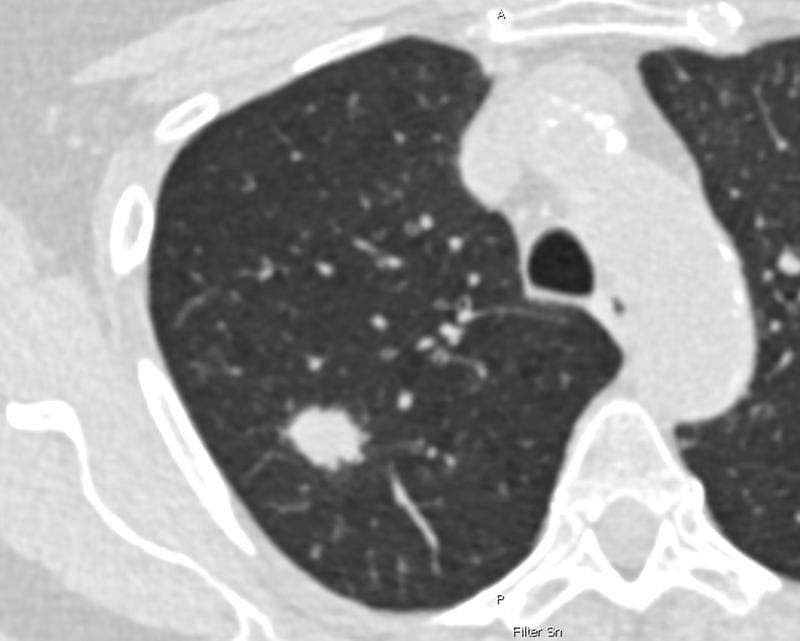Low-dose CT scan of the lungs of a 69-year-old smoker. The white, rounded area in the lung tissue indicates lung cancer in the early stages. At this stage, lung cancer can still be treated well. | Source: Jens Vogel-Claussen | Copyright: © Charité | Jens Vogel-Claussen