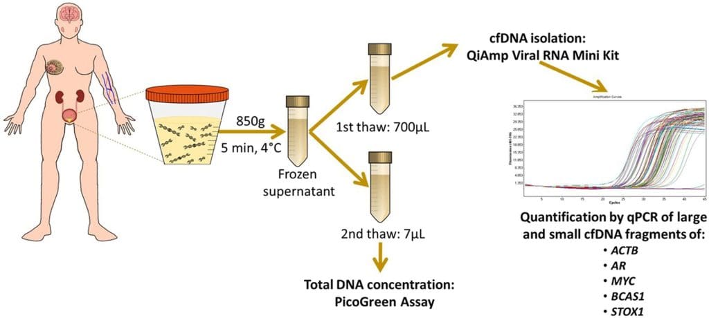 Groundbreaking research in the Journal of Molecular Diagnostics shows that analyzing specific patterns of cell-free DNA (cfDNA) fragmentation in a simple urine sample allows for effective diagnosis and staging of bladder cancer. This approach provides a much-needed alternative to invasive procedures such as cystoscopies, reducing healthcare costs and improving patient comfort and outcomes. (Source: The Journal of Molecular Diagnostics / Herranz et al.)