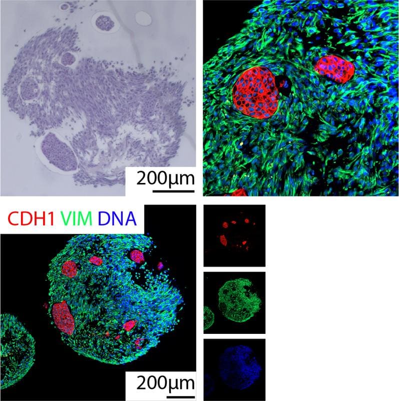 Microscopic image of a coculture of patient-derived bladder organoids and associated cancer-associated fibroblasts. The immunofluorescence images show tumor organoids of the urinary bladder (red) embedded in a fibroblastic tumor environment | Source: Dr. M.Melzer, Prof. A. Kleger | Copyright: Dr. M.Melzer, Prof. A. Kleger / Uni Ulm 