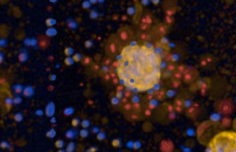 Genetically modified immune cells (CAR-T cells, blue) specifically attack three-dimensional tumor tissue (tumoroids, yellow) and kill tumor cells (visible in dead cells marked in red). | Copyright: BIH | Michael Schmück-Henneresse