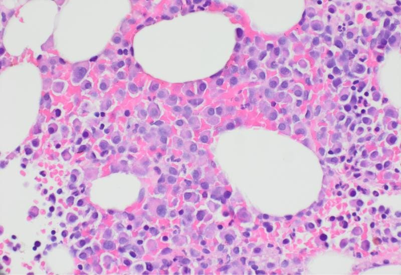 Multiple Myeloma | Copyright: © Ioannis Anagnostopoulos, Institute of Pathology, University of Würzburg