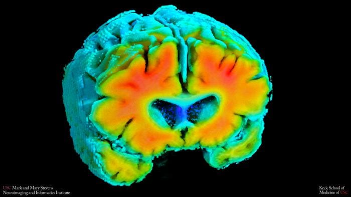 The study used amyloid PET imaging to measure plaque buildup in the brain, a hallmark of Alzheimer's disease. Warmer colors indicate higher amyloid levels. Participants with healthier patterns of cerebral blood flow and oxygen regulation had lower amyloid loads, confirming the assumption that vascular function may be associated with Alzheimer's-related changes.
Credits:
Image/Stevens INI