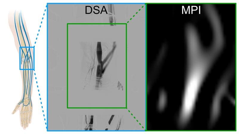 Comparison of MPI angiography (MPA) and digital subtraction angiography (DSA). The images selected from the respective real-time series show the maximum contrast-filled veins in the subject's arm. | Copyright: Philipp Gruschwitz (UKW), Patrick Vogel (JMU), Viktor Hartung (UKW)