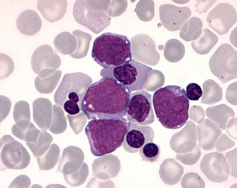 Blood from a child with Down syndrome who has transient myeloproliferative syndrome (TAM). Similar to leukemia, the microscope shows almost only the purple-colored immature precursors of the white blood cells (blasts). | Source: Jan-Henning Klusmann | Copyright: University Medical Center Frankfurt  