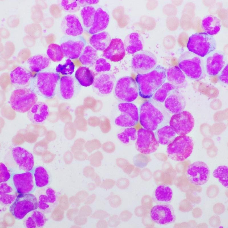 Microscopic image of cancer cells of acute myeloid leukemia (400x magnification) | Copyright: UM/Canva