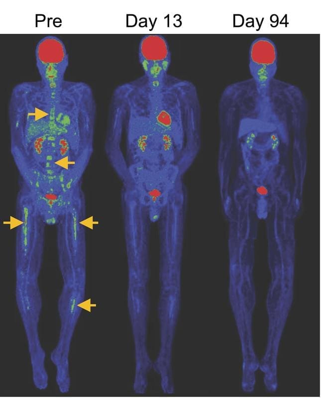 PET/CT images showing the regression of bone lesions in B cell ALL (yellow arrows) after infusion of CAR TSCM cells. | Copyright: Source: NIH   