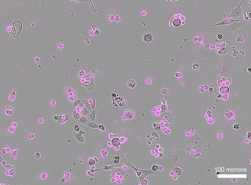 After treatment with Cas12a2, human cervical cancer cells (shown in grey) die over a large area, recognizable by the apoptosis markers (magenta). | Copyright: Liu Lab / University of Utah Health 