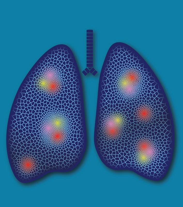 The distribution of metabolism shapes the structure of lung tumors: red, yellow and pink areas make the spatial complexity inside a lung tumor visible. Graphics | Source: Dr. Aswani Kumar Kotagir 