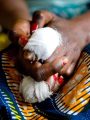 Leprosy in DR Congo - 2013 | Quelle: Harandane Dicko | Copyright: World Health Organization